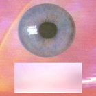Dialated thumbnail