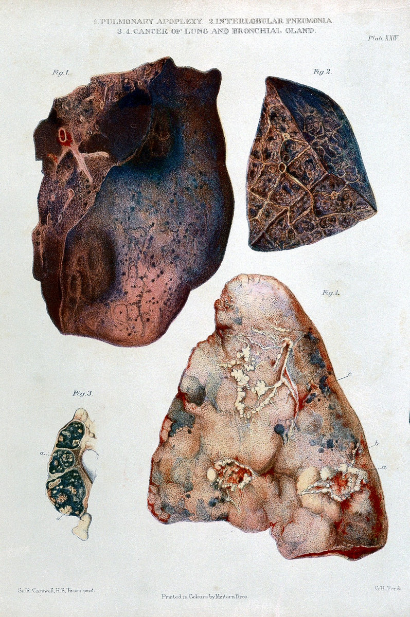 Gross Lung Pathology and Pathogensis of SARS-Cov-2 | Pneumonia