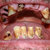 toothdecay thumbnail
