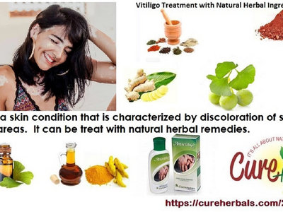 Natural Herbal Method for Vitiligo Natural Treatment main photo
