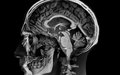 Encephalopathy image