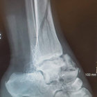 gimpleg thumbnail