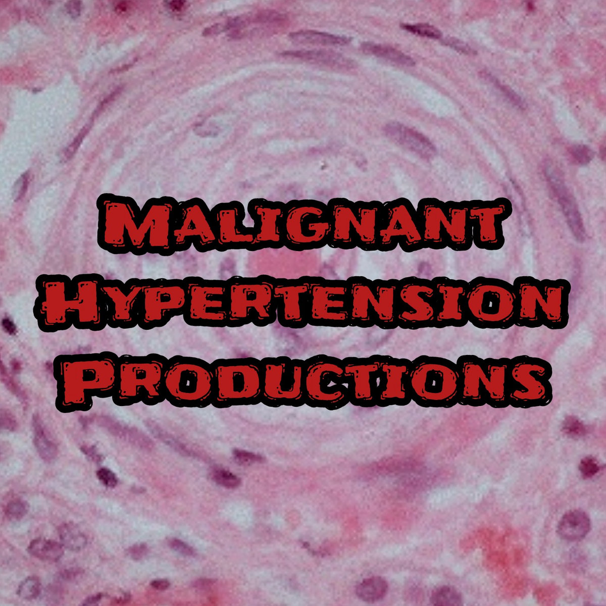 Multiple Hemorrhagic Strokes in the Cerebellum Caused by Lifelong