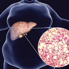Fatty Liver Hedon thumbnail