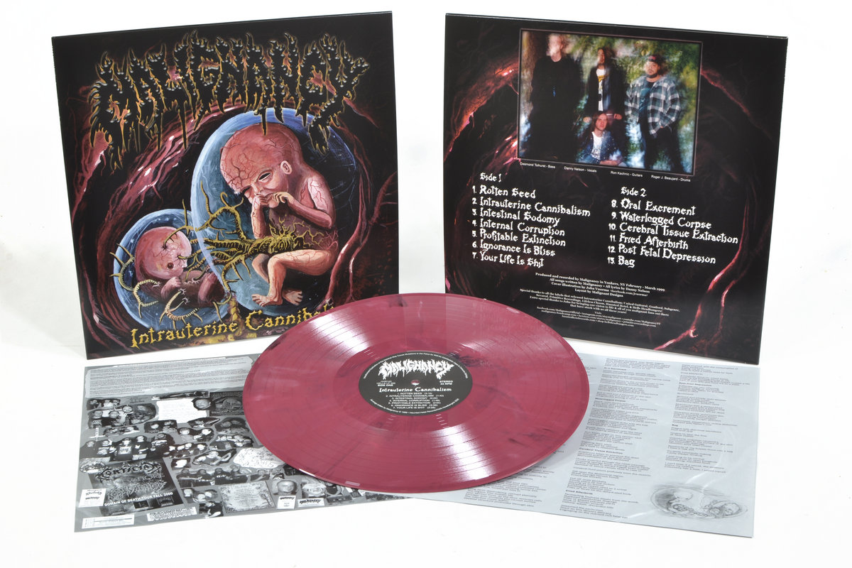 Intrauterine Cannibalism | MALIGNANCY