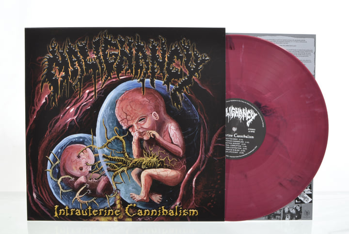 Intrauterine Cannibalism | MALIGNANCY