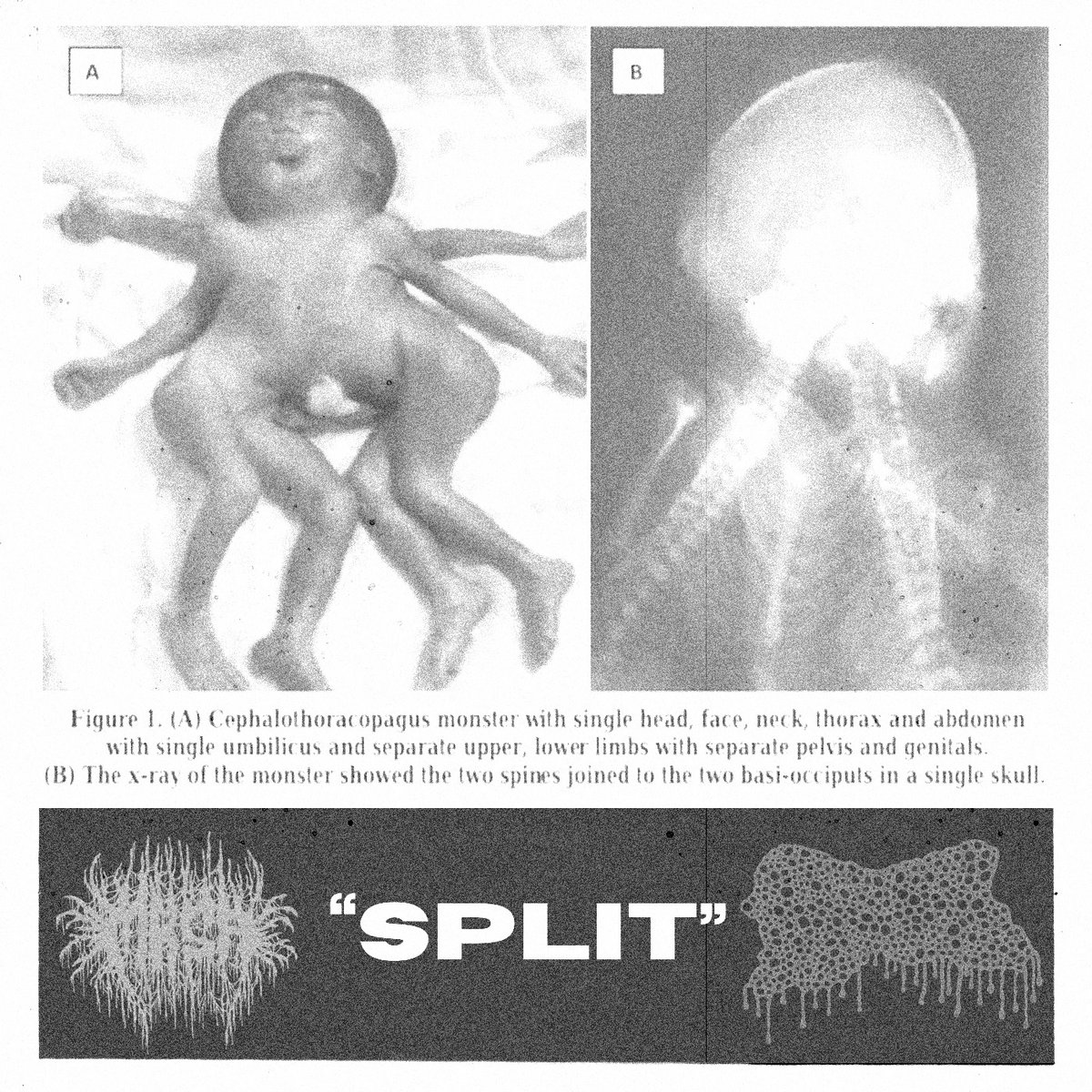 Cephalothoracopagus Monster Split w/ Craniofacial Degloving | MRSA