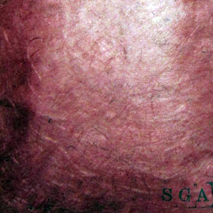 Patterned Lividity Lividity | Servant Girl Annihilator