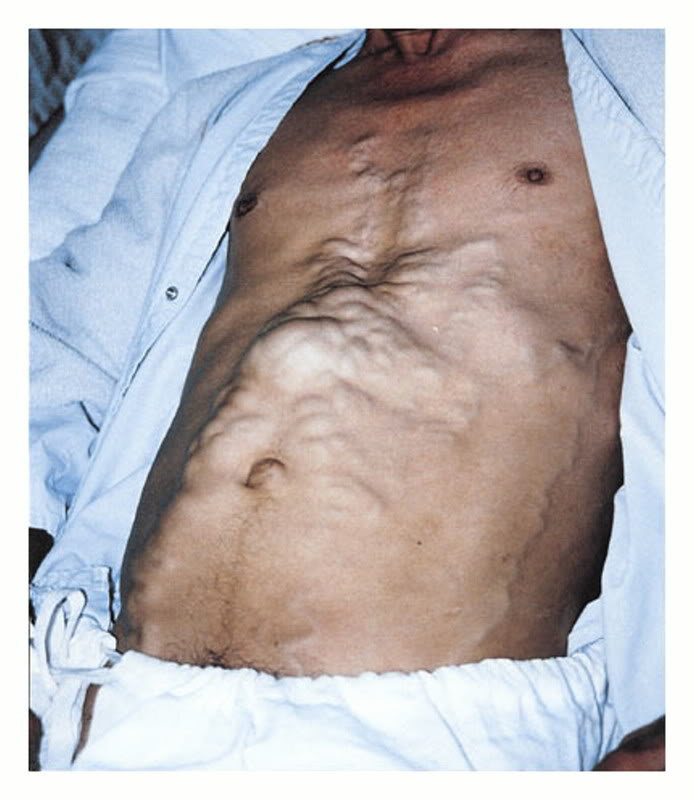 music ascites
