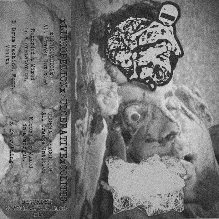 Split With Ulcerative Colitis | xLITHOPEDIONx