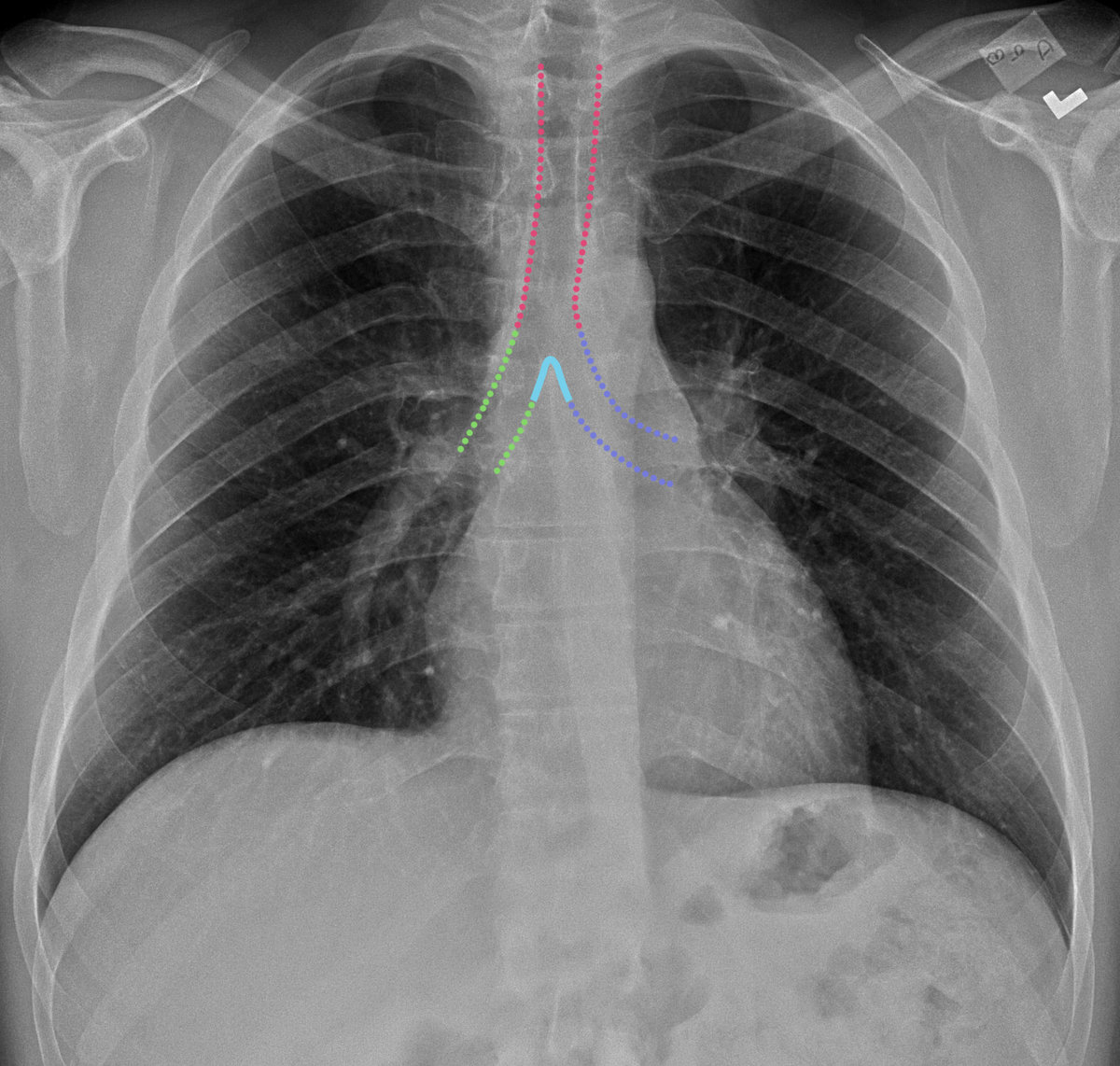 Insomnia Riff Lung Butter Insomnia (GTR RIFF) | Etched In Bone