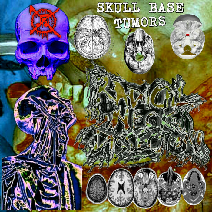 Twist Drill Vs. Burr Hole Trephination Radical Neck Dissection