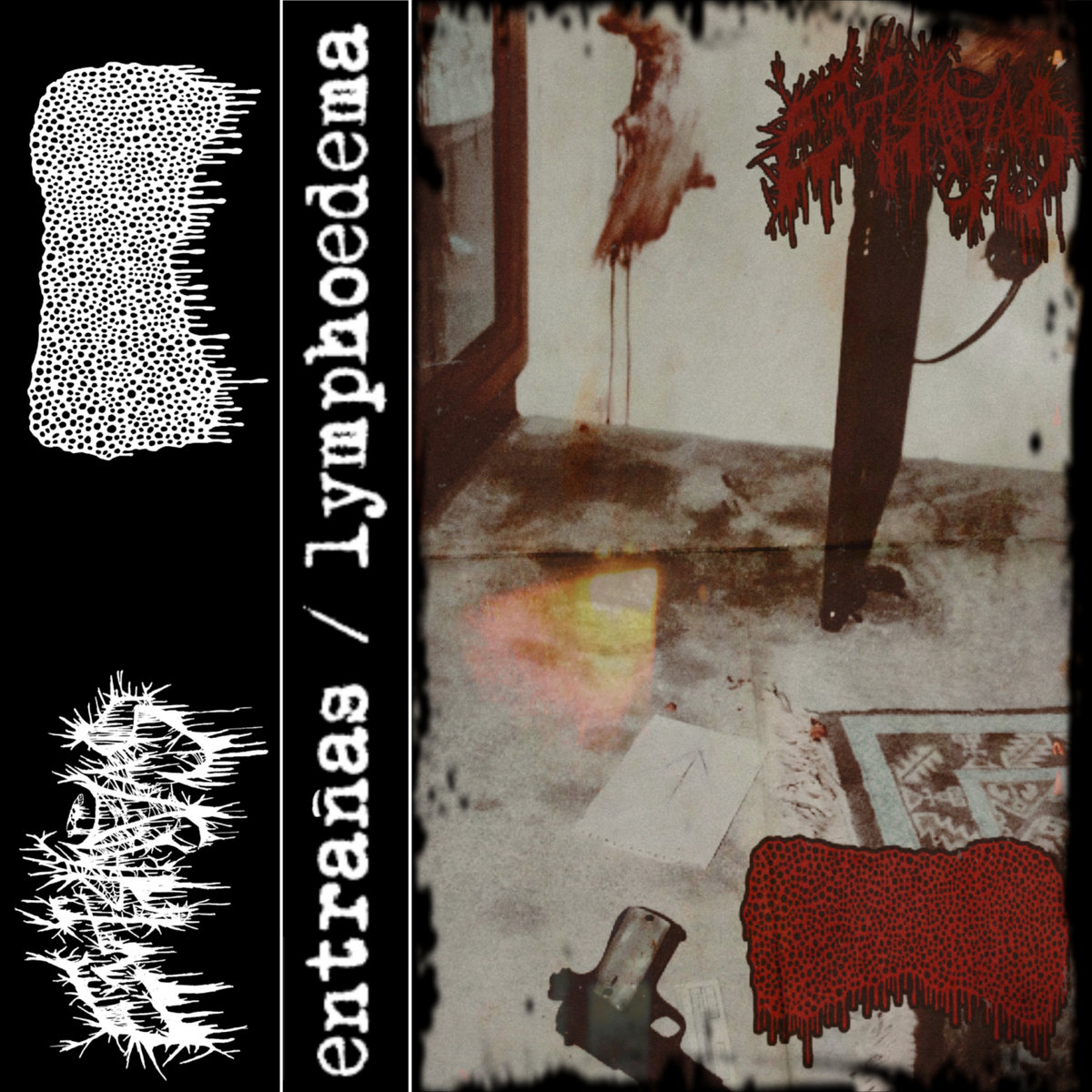 Split With Entranas Lymphoedema