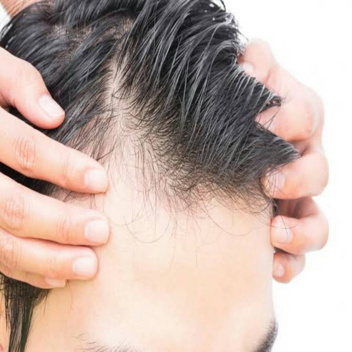Important Points Of Prp Hair Treatment You Should Consider Urdu Hindi Important Points Of Prp Hair Treatment You Should Consider Urdu Hindi