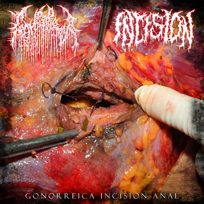 Gonorrea - Gonorrheic Drunk Porn Gore | Gonorrea | Incision