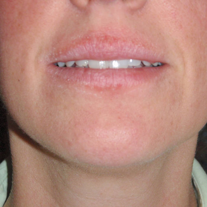 Iron Deficiency Tongue Cracked Chinese Medicine parcawatgechub