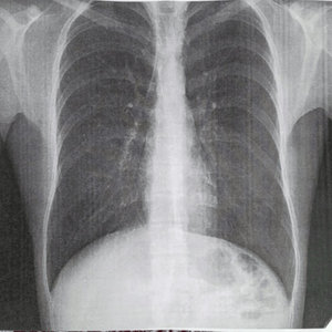 collapsing lung cover