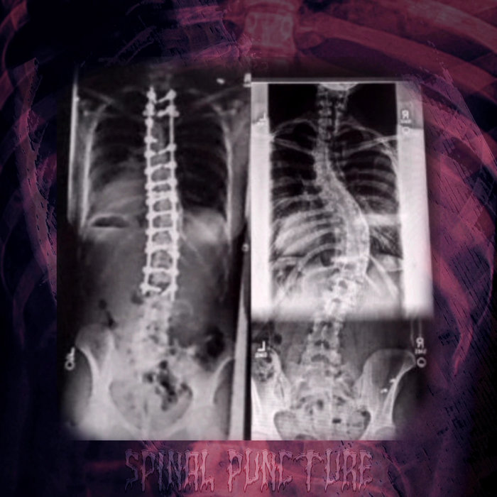 Demo Spinal Puncture Doctrine Rec.