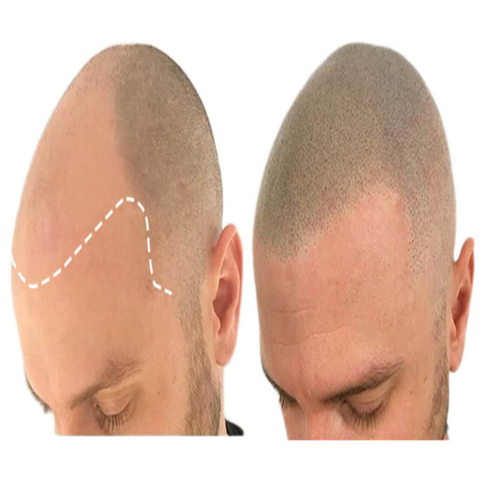 SCALP MICROPIGMENTATION TORONTO drhairtattoo