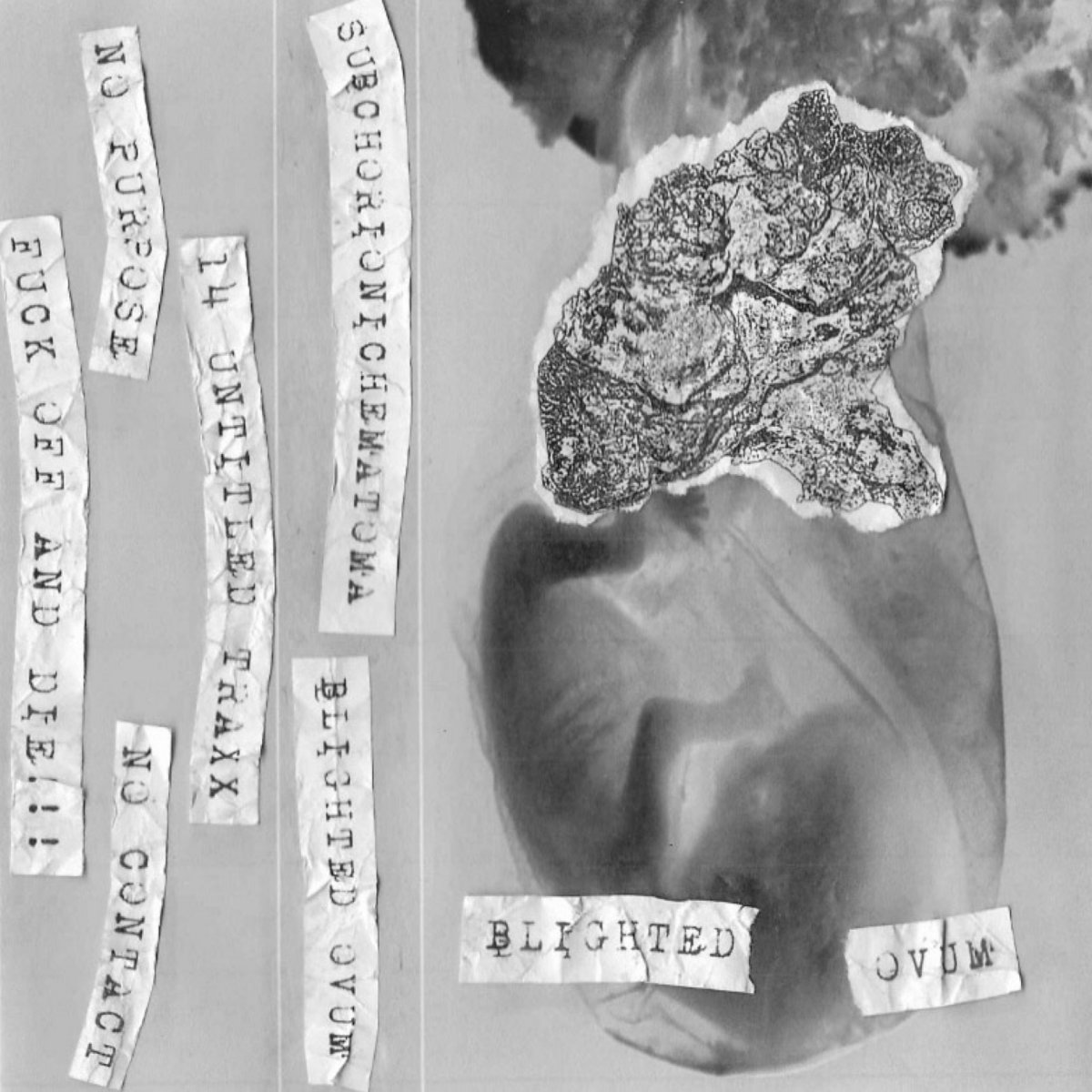 SUBCHORIONIC HEMATOMA "BLIGHTED OVUM" SUBCHORIONIC HEMATOMA