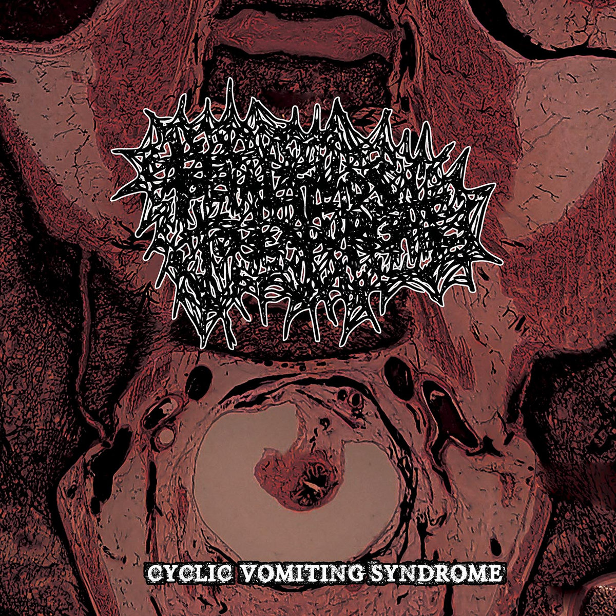 gabapentin cyclic vomiting