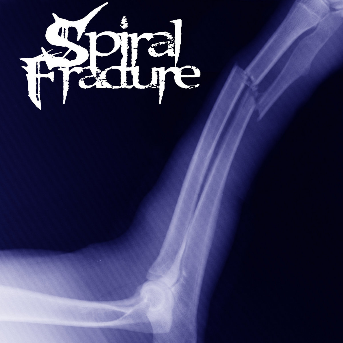 Spiral Fracture Spiral Fracture