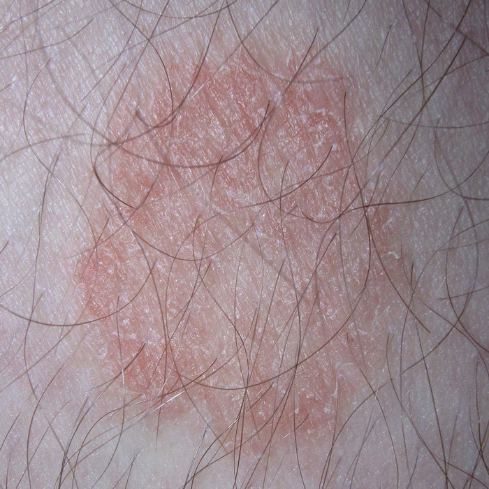 dermatophytosis-kf6gpe