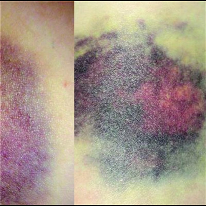 Split | Bruising Pattern