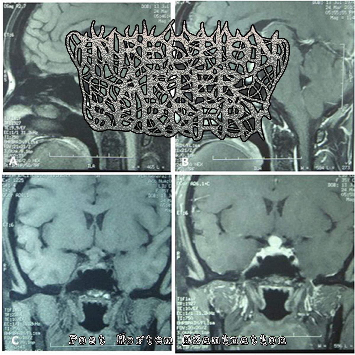 Post Mortem Examination Infection After Surgery Unauthorized Surgeons Club