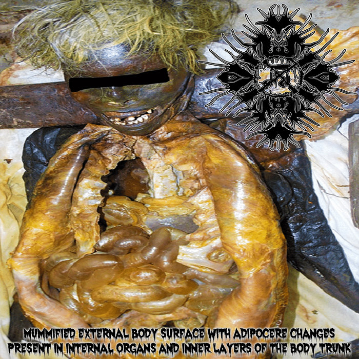 Mummified external body surface with adipocere changes present in ...