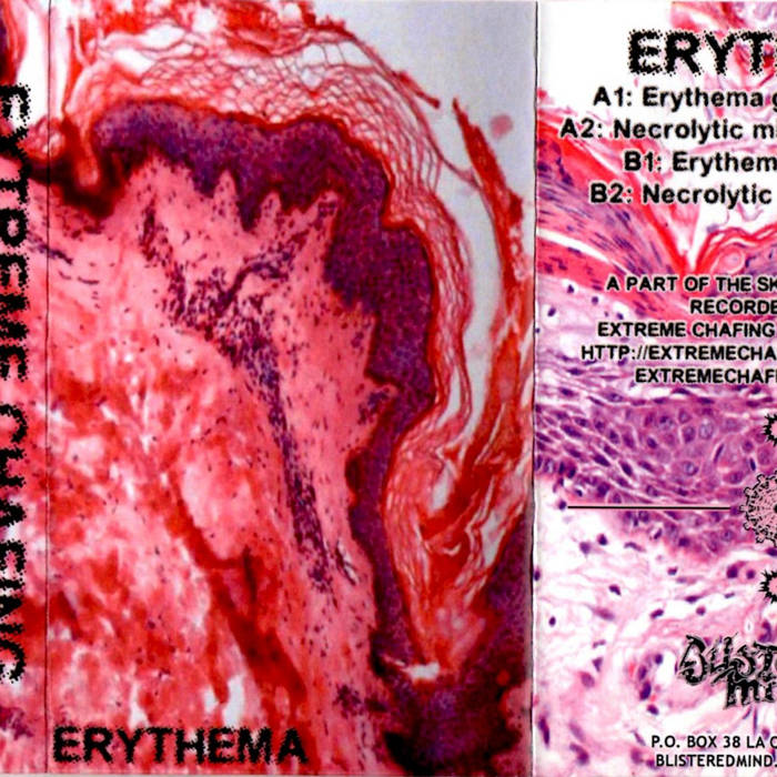 Erythema | Extreme Chafing