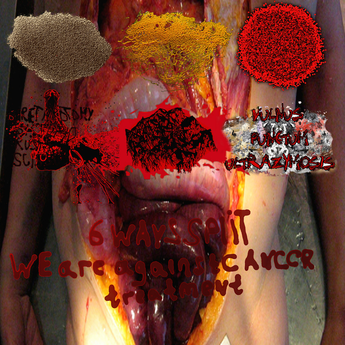 uxbxsxrxsx woman with giant ovarian cyst crushed the children and