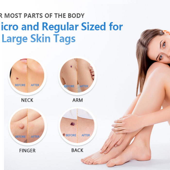 Natural Skin Essence Skin Tag Remover
